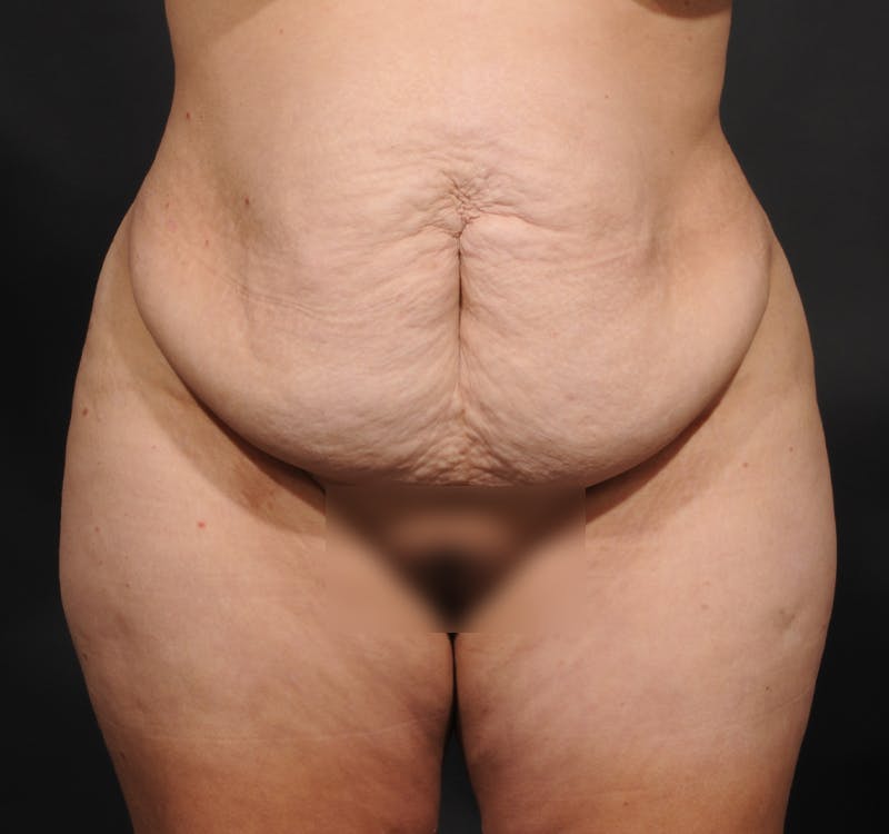 Tummy Tuck Before & After Gallery - Patient 363870 - Image 1