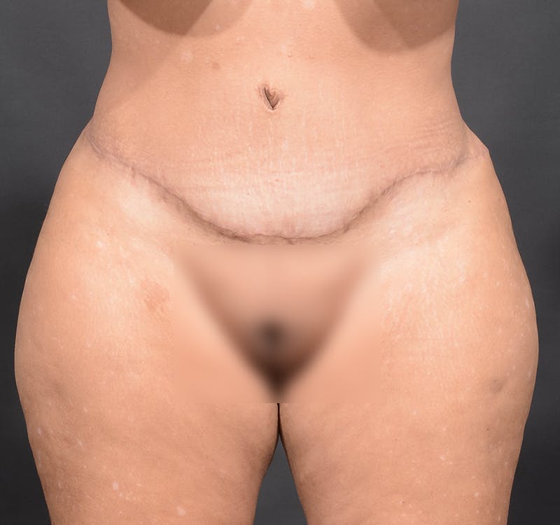 Tummy Tuck Before & After Gallery - Patient 363870 - Image 2
