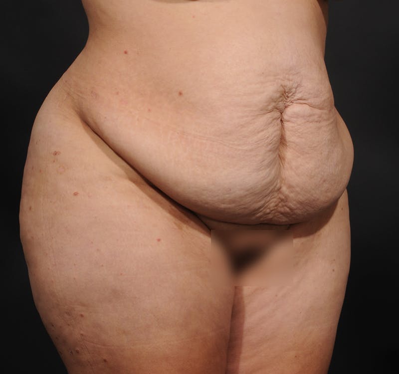 Tummy Tuck Before & After Gallery - Patient 363870 - Image 3