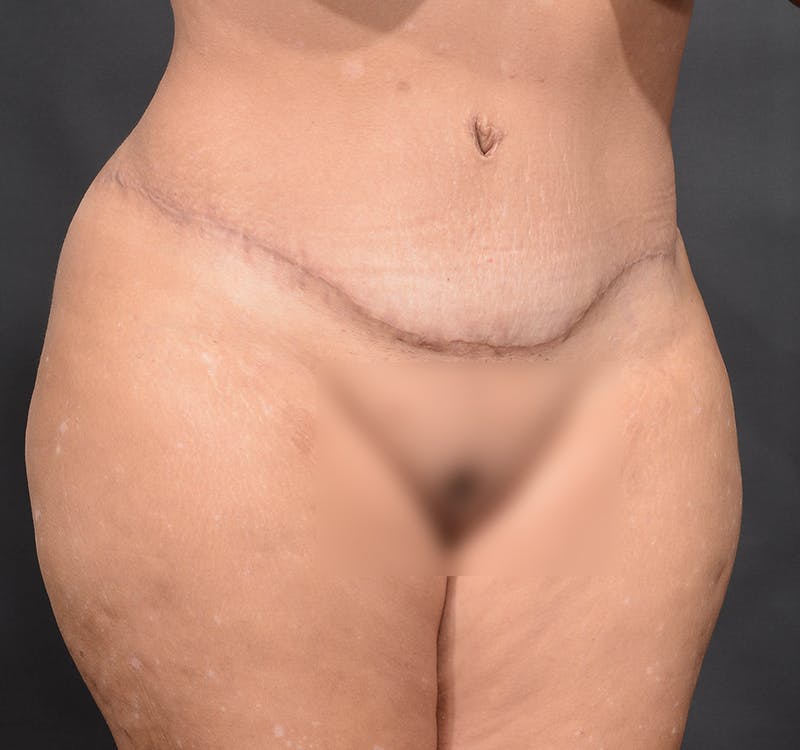 Tummy Tuck Before & After Gallery - Patient 363870 - Image 4