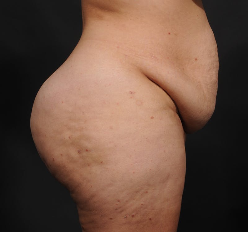 Tummy Tuck Before & After Gallery - Patient 363870 - Image 5