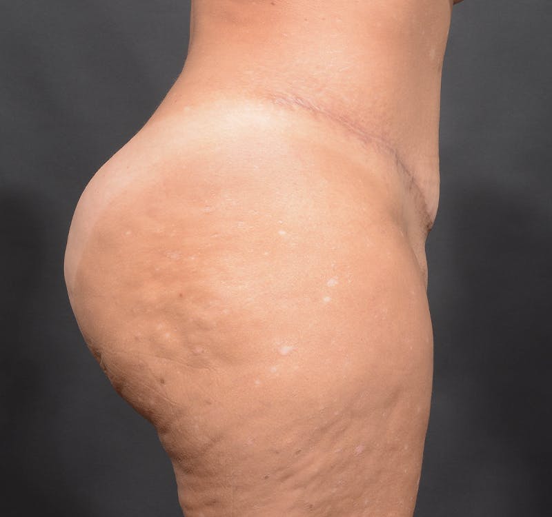 Tummy Tuck Before & After Gallery - Patient 363870 - Image 6