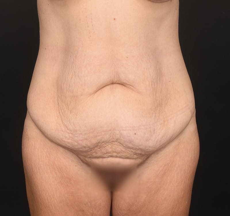 Tummy Tuck Before & After Gallery - Patient 260659 - Image 1