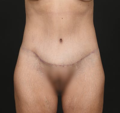 Tummy Tuck Before & After Gallery - Patient 260659 - Image 2