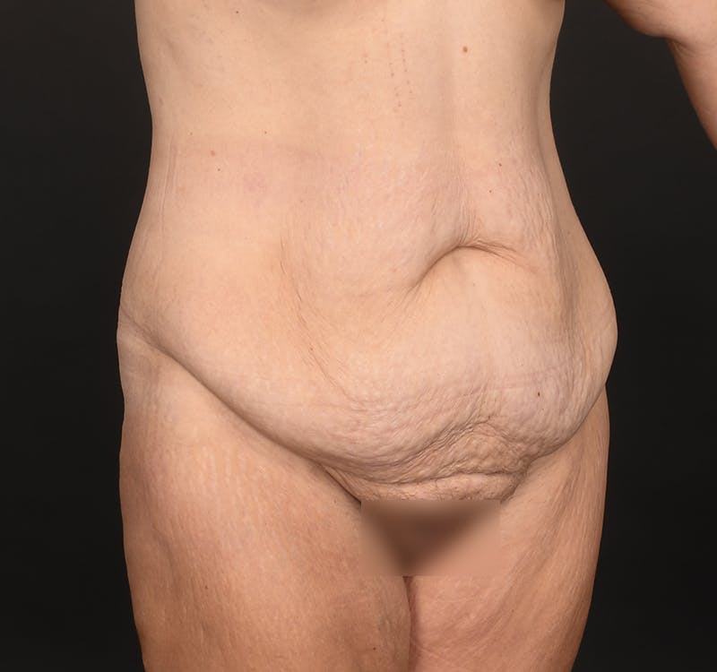 Tummy Tuck Before & After Gallery - Patient 260659 - Image 3