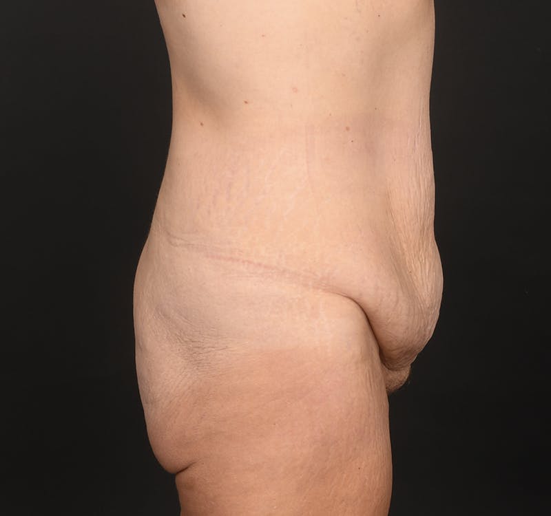 Tummy Tuck Before & After Gallery - Patient 260659 - Image 5