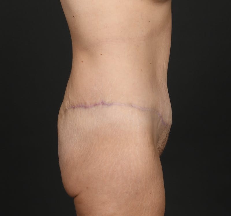 Tummy Tuck Before & After Gallery - Patient 260659 - Image 6