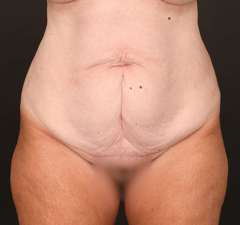 Tummy Tuck Before & After Gallery - Patient 164530 - Image 1