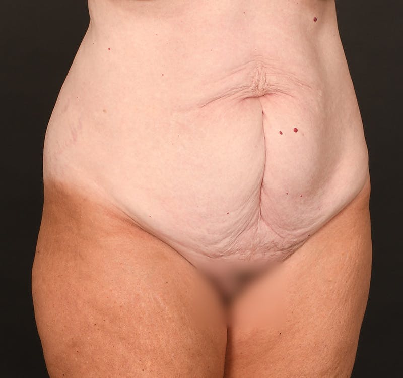 Tummy Tuck Before & After Gallery - Patient 164530 - Image 3