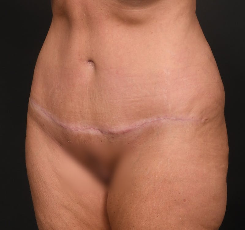 Tummy Tuck Before & After Gallery - Patient 164530 - Image 6