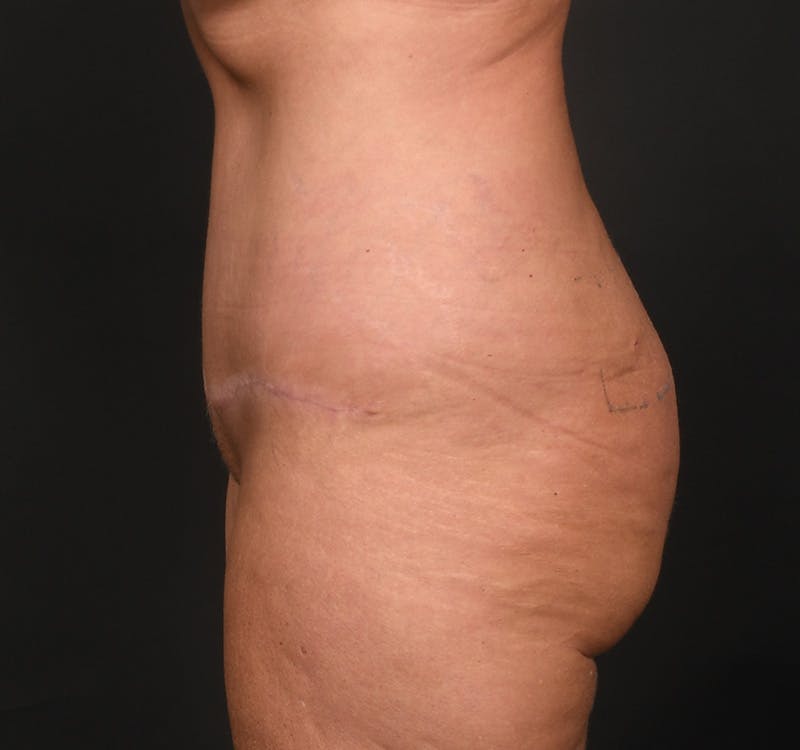 Tummy Tuck Before & After Gallery - Patient 164530 - Image 8