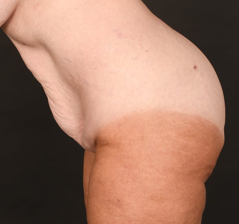 Tummy Tuck Before & After Gallery - Patient 164530 - Image 9