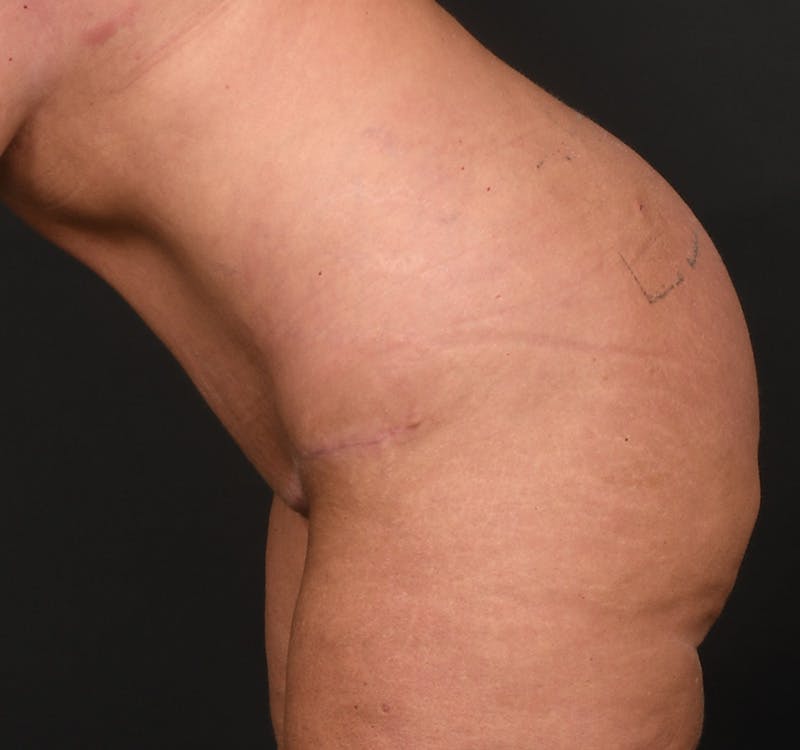 Tummy Tuck Before & After Gallery - Patient 164530 - Image 10