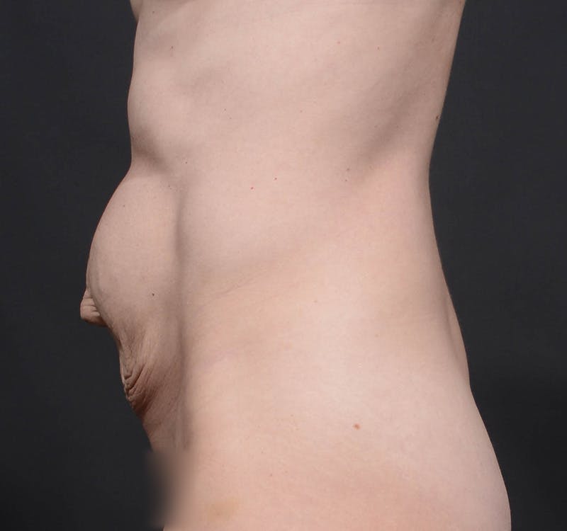 Tummy Tuck Before & After Gallery - Patient 568470 - Image 7