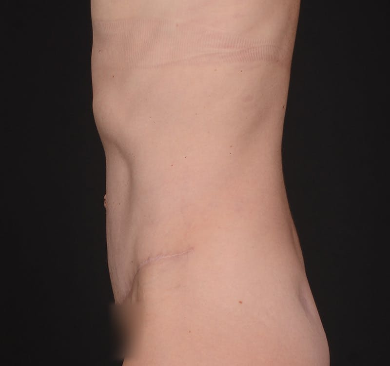 Tummy Tuck Before & After Gallery - Patient 568470 - Image 8