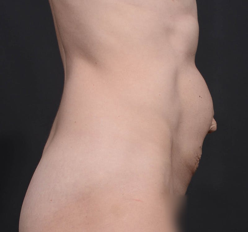 Tummy Tuck Before & After Gallery - Patient 568470 - Image 9