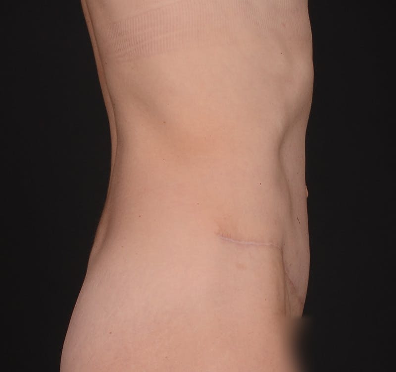 Tummy Tuck Before & After Gallery - Patient 568470 - Image 10