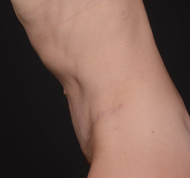 Tummy Tuck Before & After Gallery - Patient 568470 - Image 12