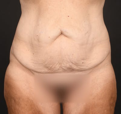 Tummy Tuck Before & After Gallery - Patient 787327 - Image 1