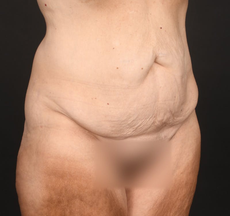 Tummy Tuck Before & After Gallery - Patient 787327 - Image 3