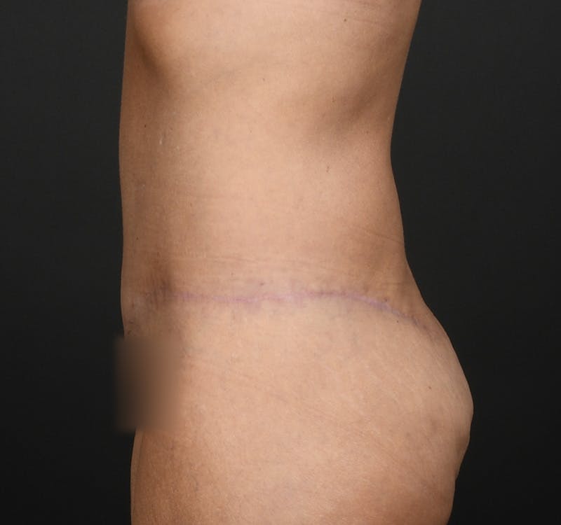Tummy Tuck Before & After Gallery - Patient 787327 - Image 8