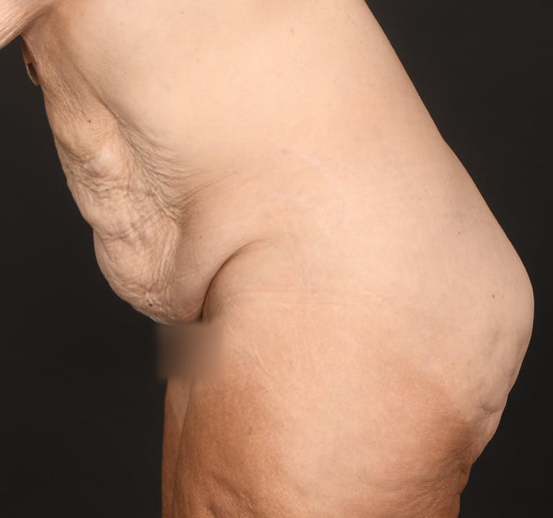 Tummy Tuck Before & After Gallery - Patient 787327 - Image 9