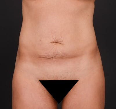 Tummy Tuck Before & After Gallery - Patient 204456 - Image 1