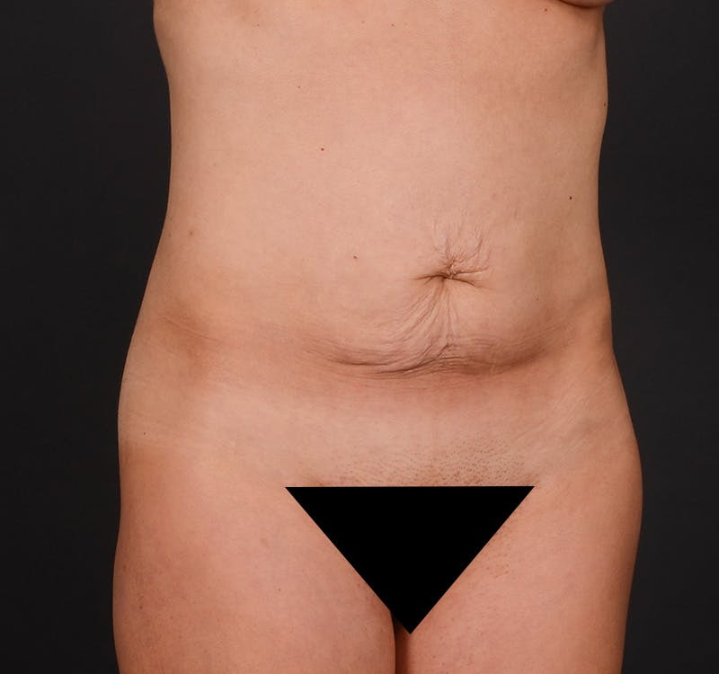 Tummy Tuck Before & After Gallery - Patient 204456 - Image 3