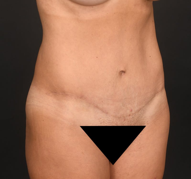 Tummy Tuck Before & After Gallery - Patient 204456 - Image 4