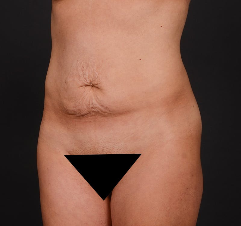 Tummy Tuck Before & After Gallery - Patient 204456 - Image 7