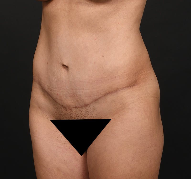 Tummy Tuck Before & After Gallery - Patient 204456 - Image 8