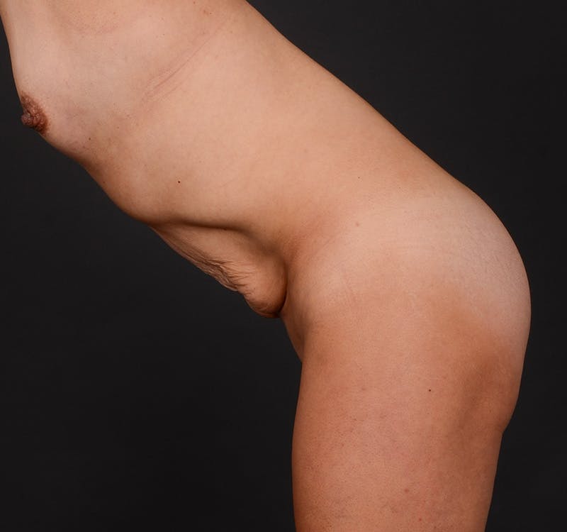 Tummy Tuck Before & After Gallery - Patient 204456 - Image 9