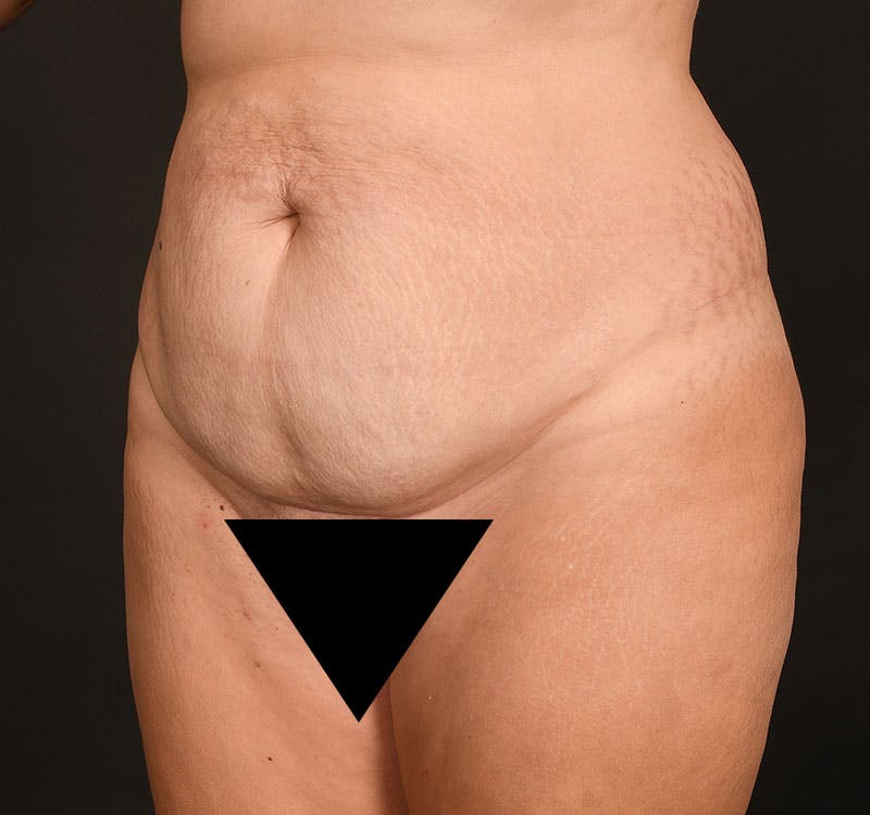 Liposuction Before & After Gallery - Patient 231523 - Image 3