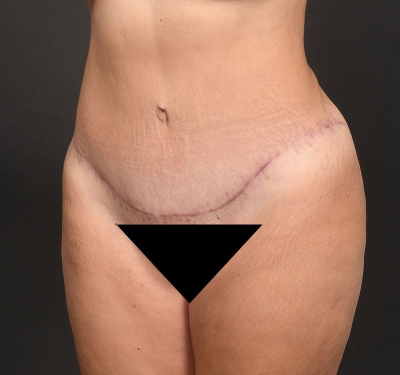 Liposuction Before & After Gallery - Patient 231523 - Image 4