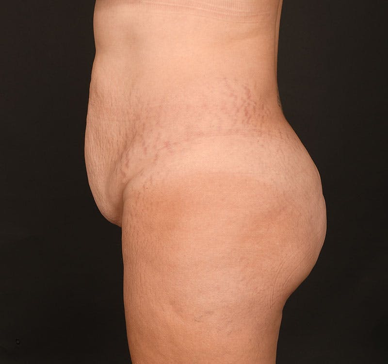 Liposuction Before & After Gallery - Patient 231523 - Image 5