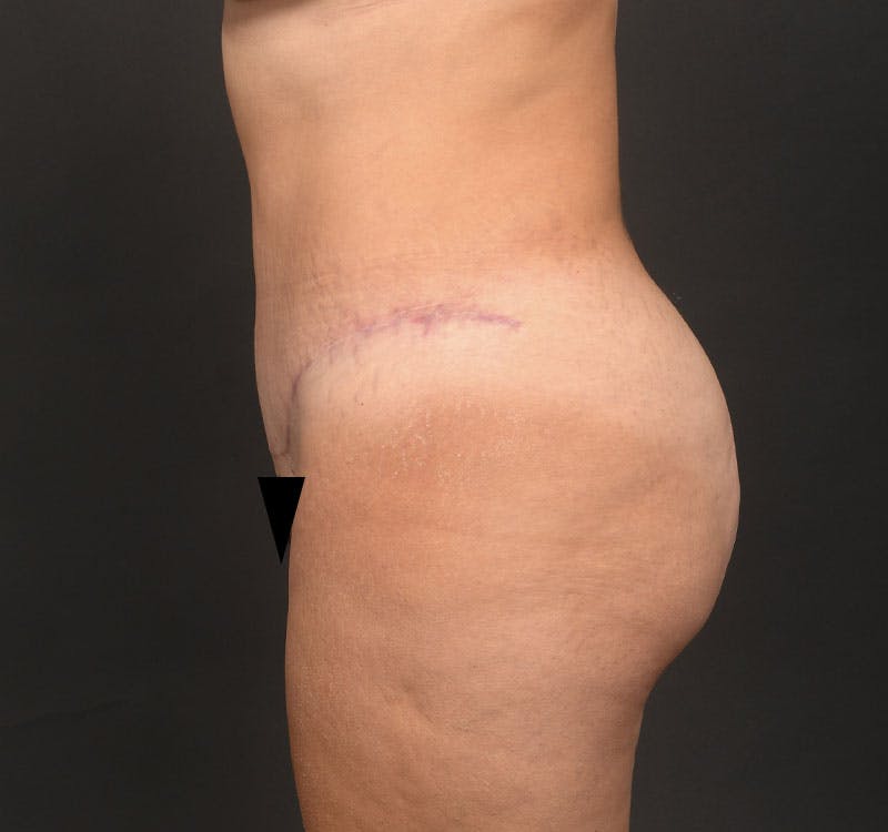 Liposuction Before & After Gallery - Patient 231523 - Image 6