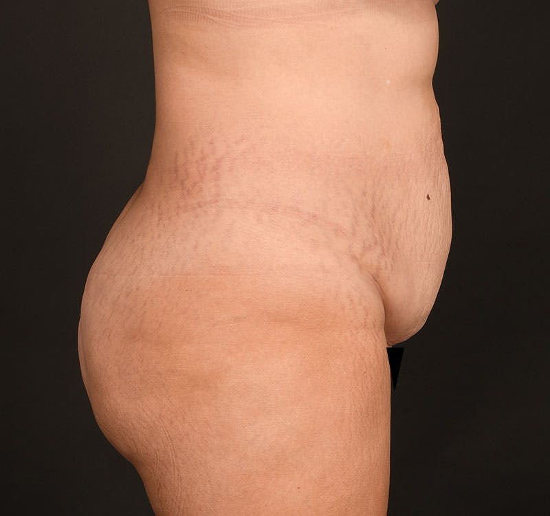 Liposuction Before & After Gallery - Patient 231523 - Image 7