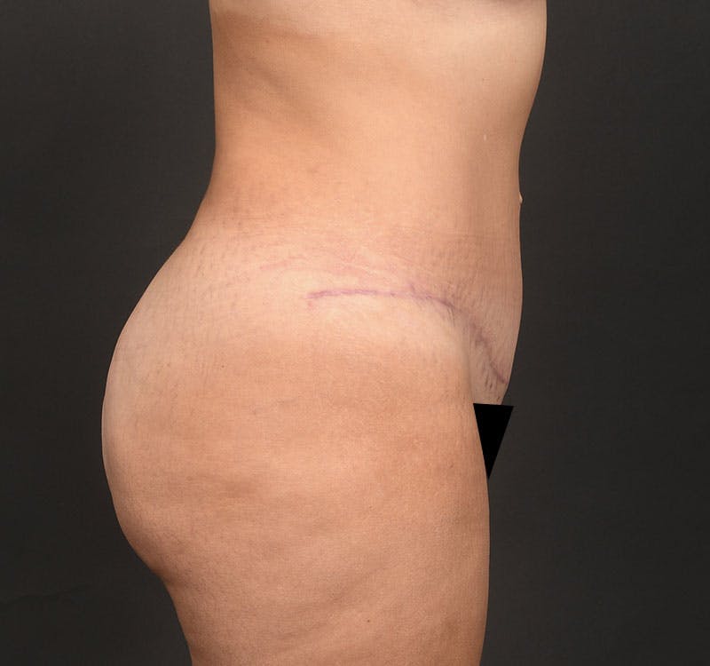 Liposuction Before & After Gallery - Patient 231523 - Image 8