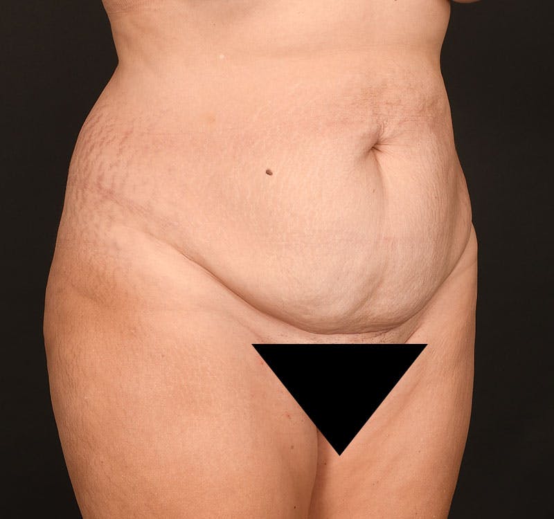 Liposuction Before & After Gallery - Patient 231523 - Image 9