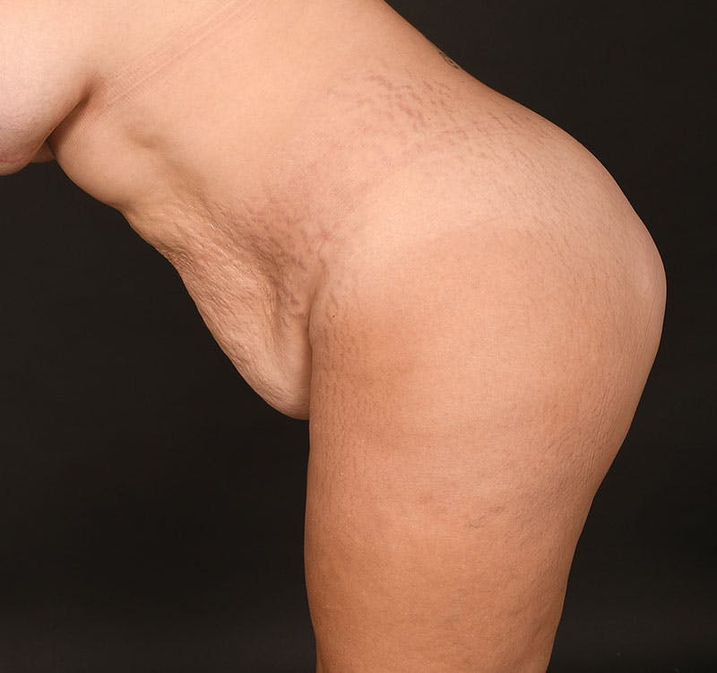 Liposuction Before & After Gallery - Patient 231523 - Image 11