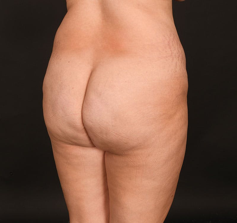 Liposuction Before & After Gallery - Patient 231523 - Image 13