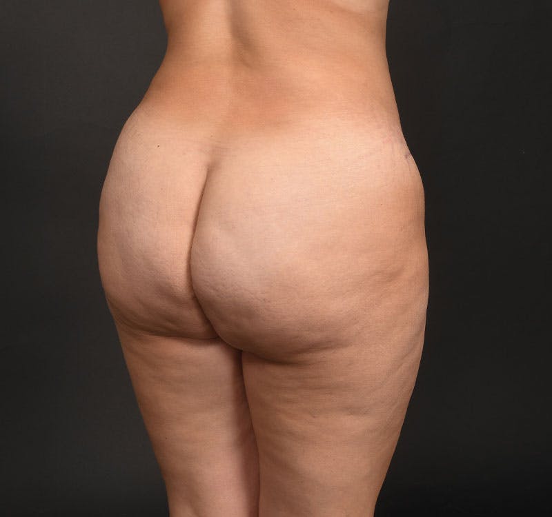 Liposuction Before & After Gallery - Patient 231523 - Image 14