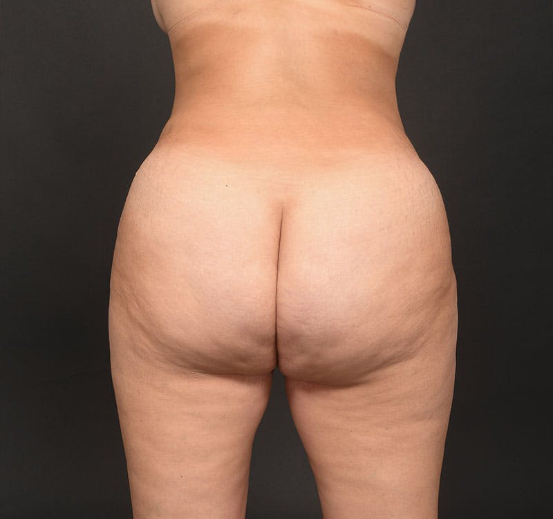 Liposuction Before & After Gallery - Patient 231523 - Image 18