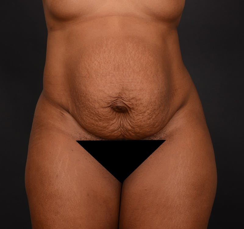 Tummy Tuck Before & After Gallery - Patient 165909 - Image 1