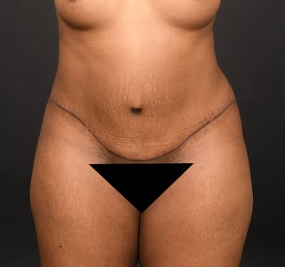 Tummy Tuck Before & After Gallery - Patient 165909 - Image 2