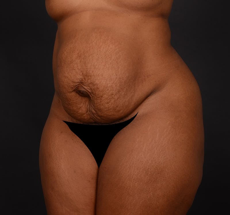 Tummy Tuck Before & After Gallery - Patient 165909 - Image 3