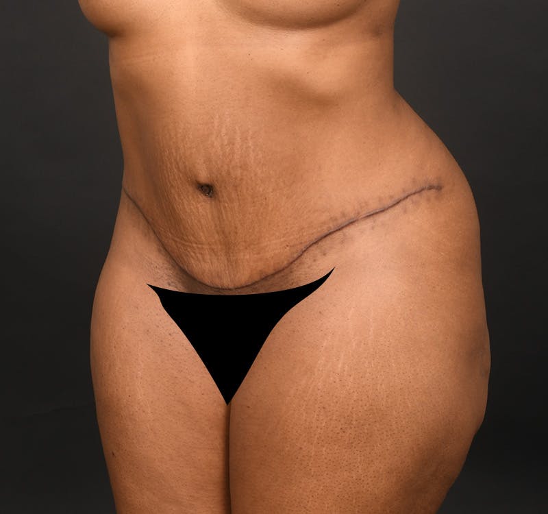 Tummy Tuck Before & After Gallery - Patient 165909 - Image 4