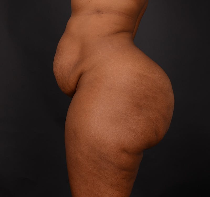 Tummy Tuck Before & After Gallery - Patient 165909 - Image 5