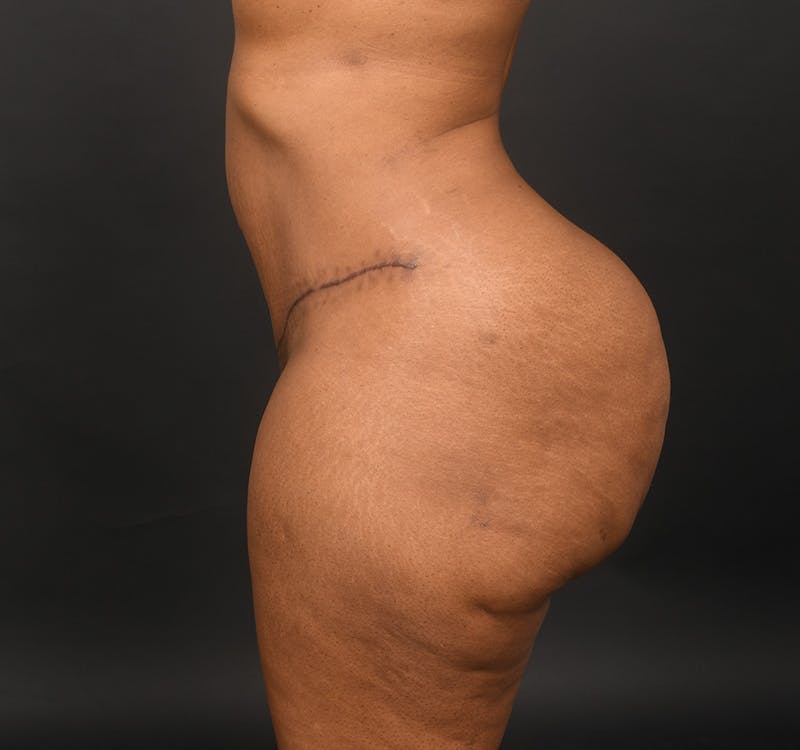 Tummy Tuck Before & After Gallery - Patient 165909 - Image 6
