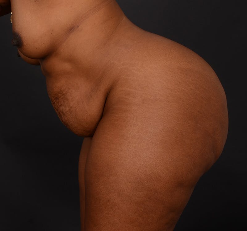 Tummy Tuck Before & After Gallery - Patient 165909 - Image 7